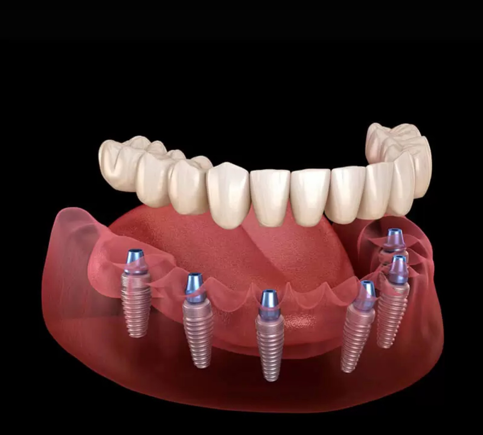 Prótese protocolo sobre implantes