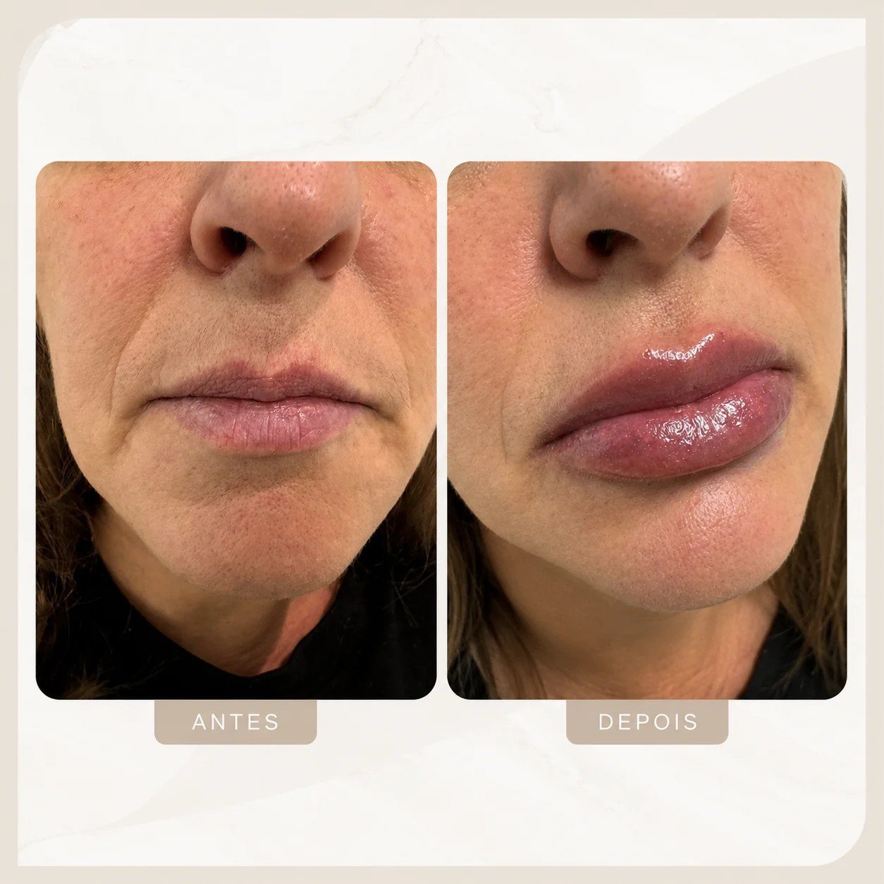 Caso clínico autorizado de preenchimento labial